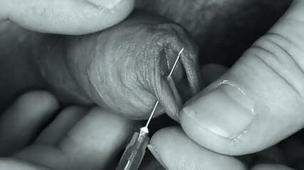 Needle in my Foreskin. Outch !